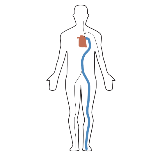 Pulswellengeschwindigkeit, Pulse wave velocity, PWV